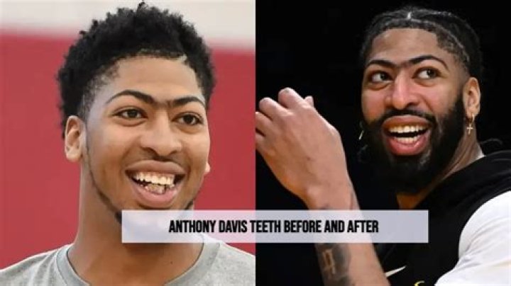 Unveiling Anthony Davis' Dental Transformation: Discoveries And Insights