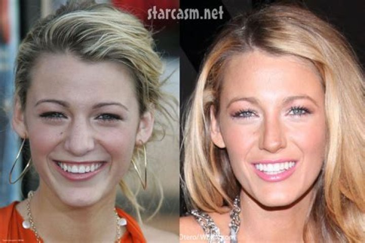 A Comprehensive Guide To Her Nose Transformation