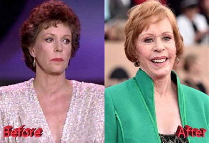 Unveiling The Secrets Of The Carol Burnett Face Lift: Discoveries And Insights