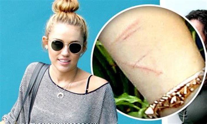 Celebrities And The Hidden Scars Of Self-Harm