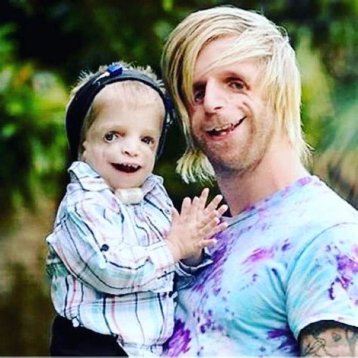 Celebrities With Treacher Collins Syndrome