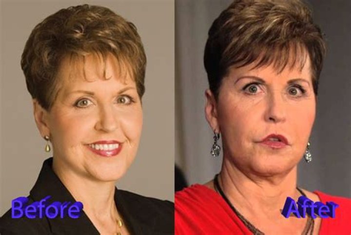 Joyce Meyer Plastic Surgery: Discoveries And Insights Uncovered!