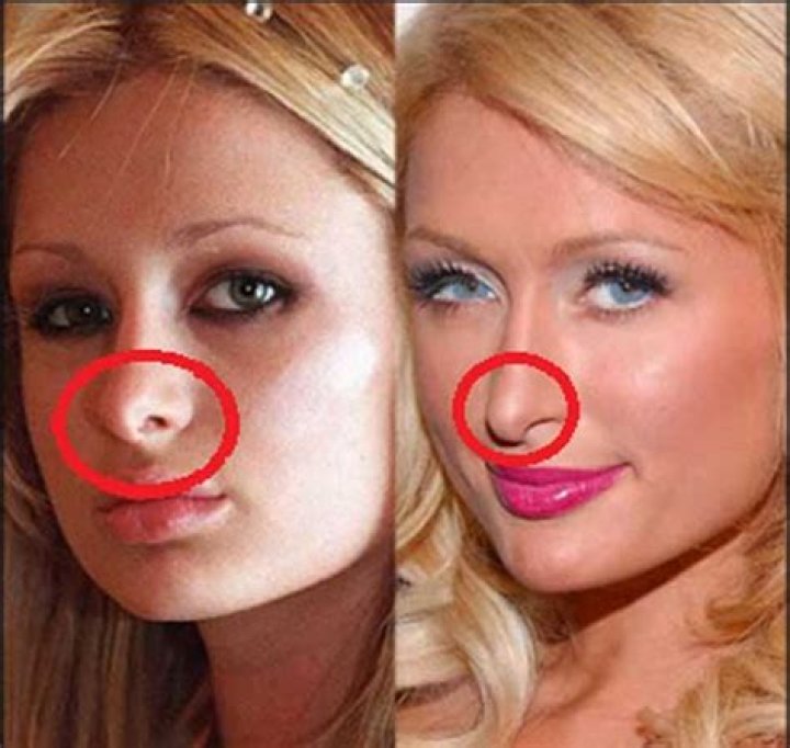 Paris Hilton's Nose Job: Uncovering The Enigma