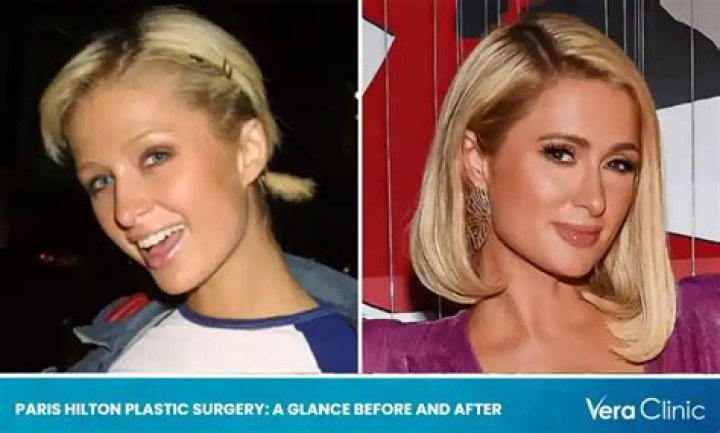 Did Paris Hilton's Transformation Involve Cosmetic Surgery?