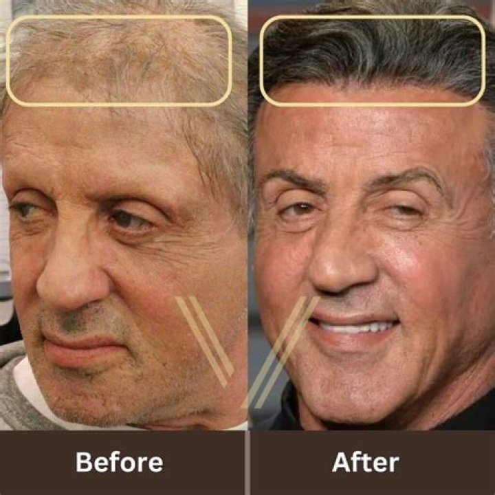 Sylvester Stallone's Hair Restoration Journey