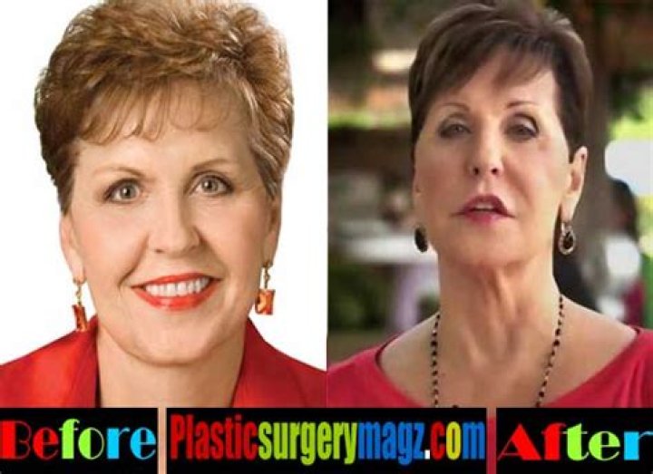Joyce Meyer's Plastic Surgery Journey: Unveiling The Truth