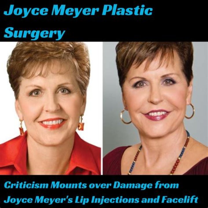 Joyce Meyer And The Plastic Surgery Journey