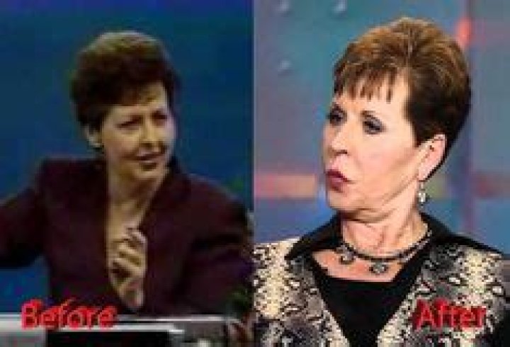 Uncover The Truth About Joyce Meyer's Facial Surgery: Discoveries And Insights