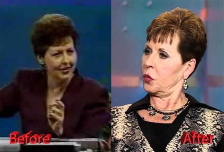 Joyce Meyer's Plastic Surgery Journey And Its Impact