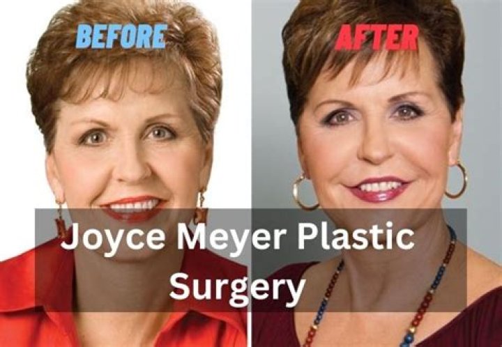 Unveiling The Secrets Of Joyce Meyer's Plastic Surgery Journey