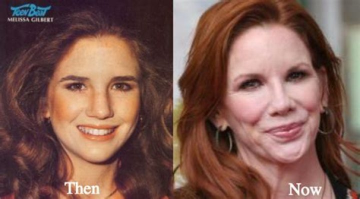 Unveiling The Secrets Of Melissa Gilbert's Plastic Surgery Journey