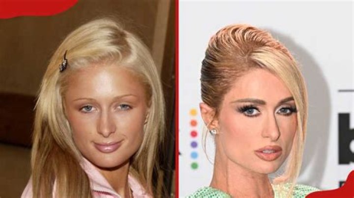 Paris Hilton's Cosmetic Journey Explored