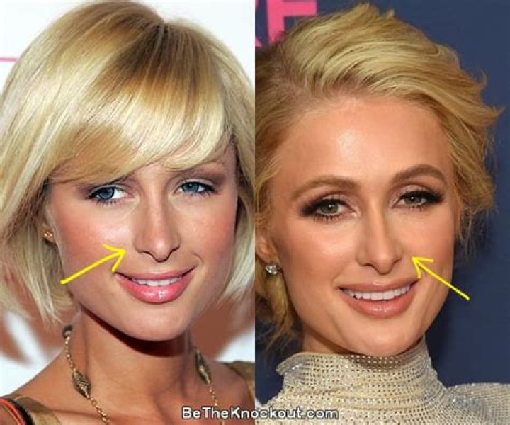 Unveiling The Secrets Of Paris Hilton's Plastic Surgery: Discoveries And Insights