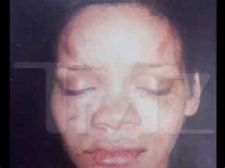 Rihanna's Injuries And Their Profound Influence