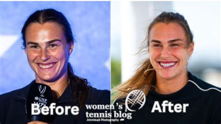 Unveiling The Secrets Of Sabalenka's Plastic Surgery Transformation
